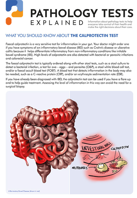 Calprotectin (Inflammatory Bowel Disease)